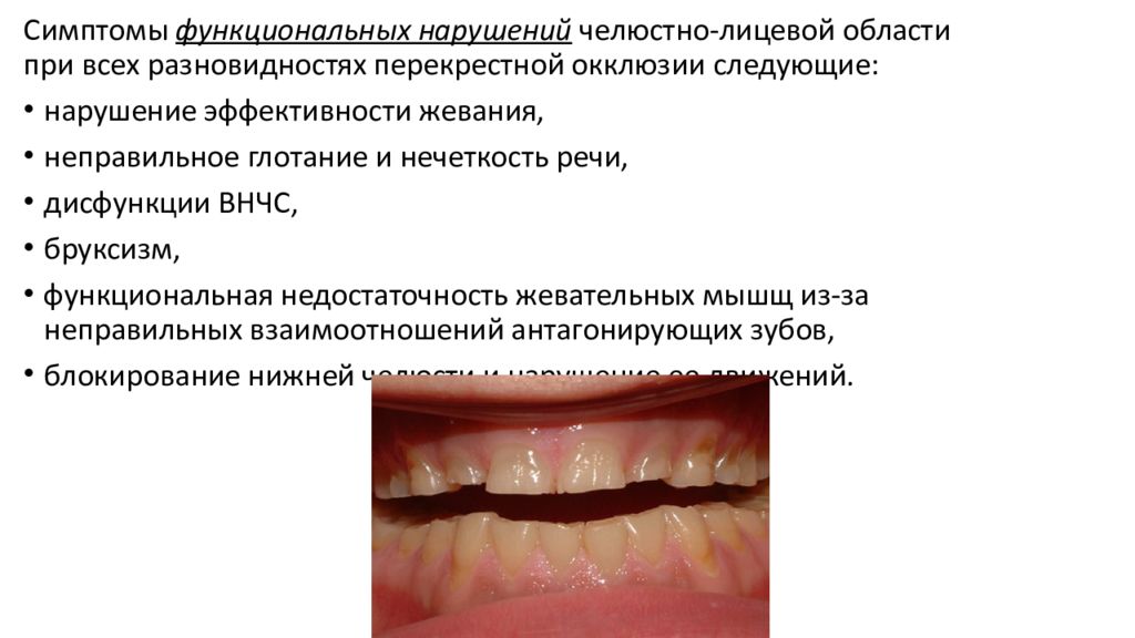 Перекрестная окклюзия