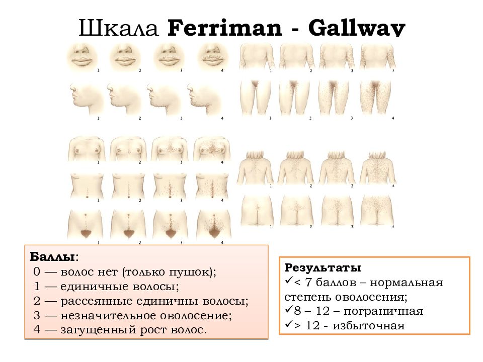 Во сколько начинает расти. Степень оволосения. Стадии оволосения у девочек. Шкала оволосения. Степень оволосения у девушек.