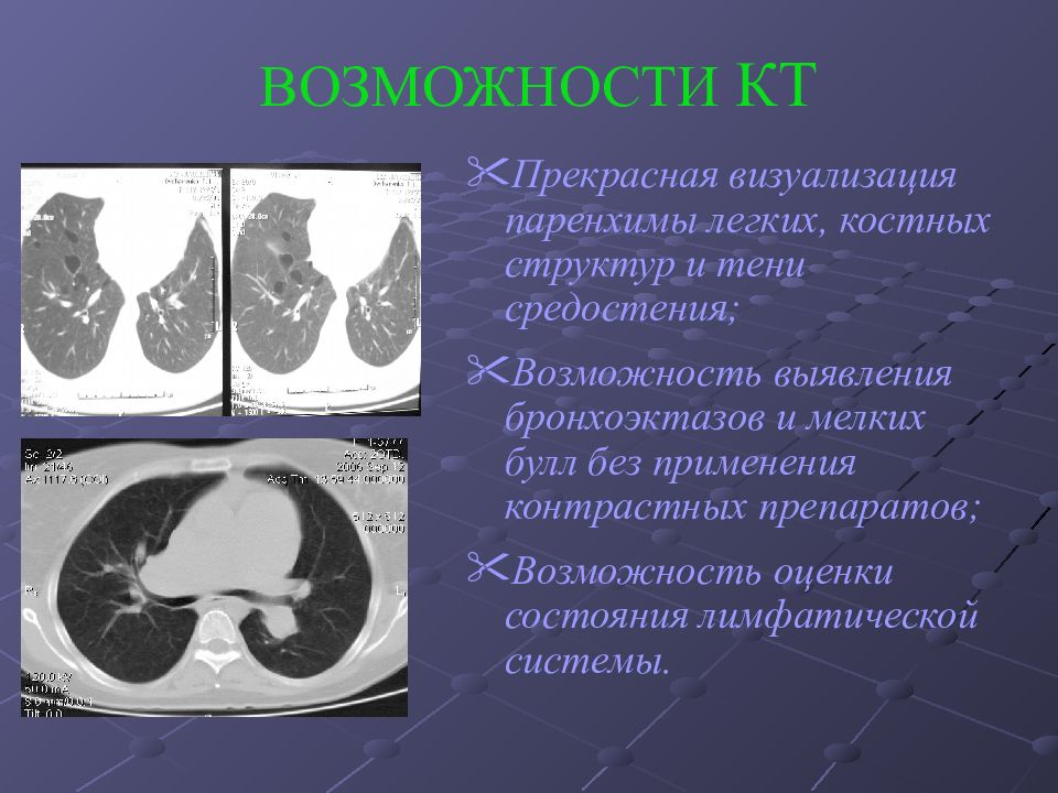 Поствоспалительные изменения в легких на кт. Поражение легочной паренхимы. Диагностические возможности кт. Паренхима легких. Заболевания паренхимы легких.