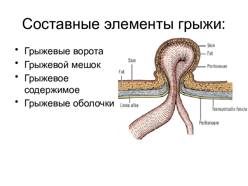 Грыжевой мешок. Составные элементы грыжи. Из чего состоит грыжевой мешок. Составные элементы грыжи схема. Строение грыжевого мешка.