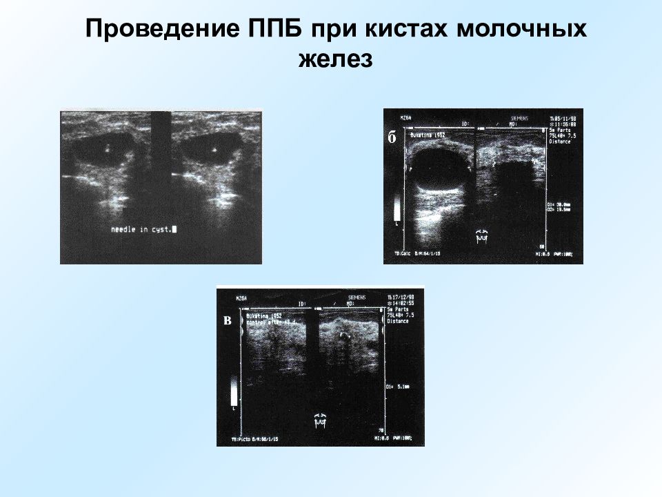 Кисты молочных желез нужно удалять