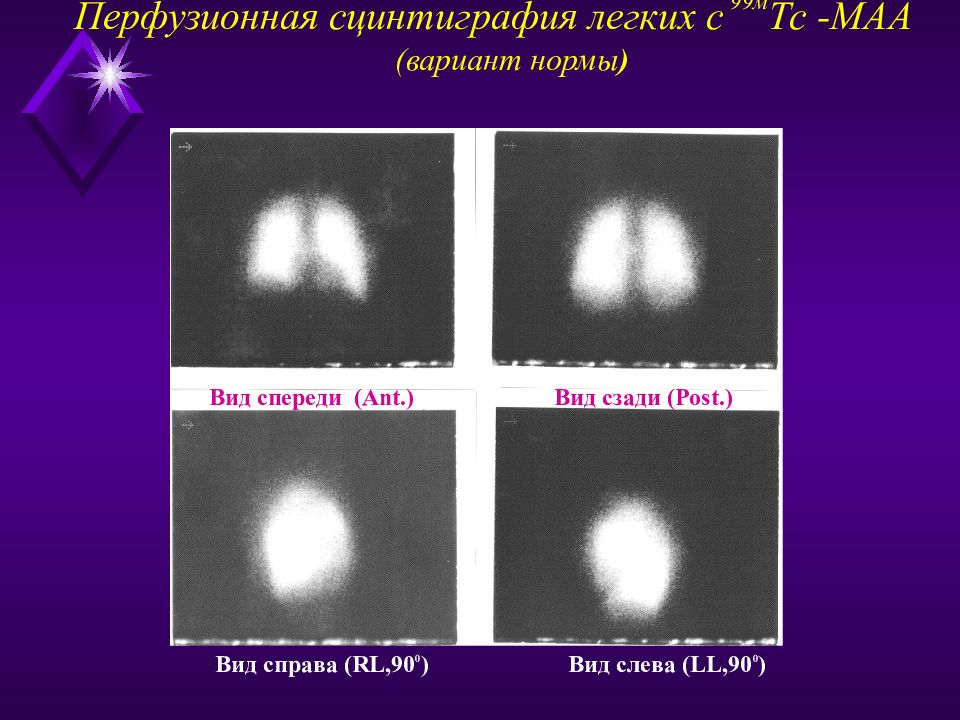 Что такое сцинтиграфия