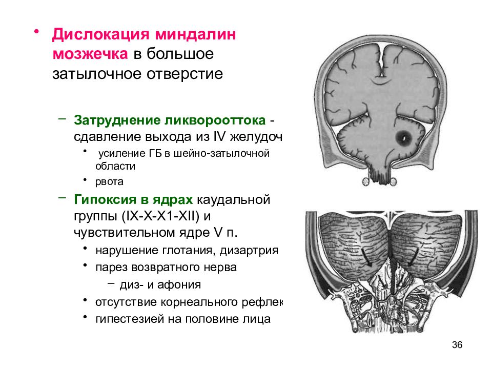 Мозжечок на уровне миндалин. Дислокация миндалин мозжечка. Большое затылочное отверстие черепа.