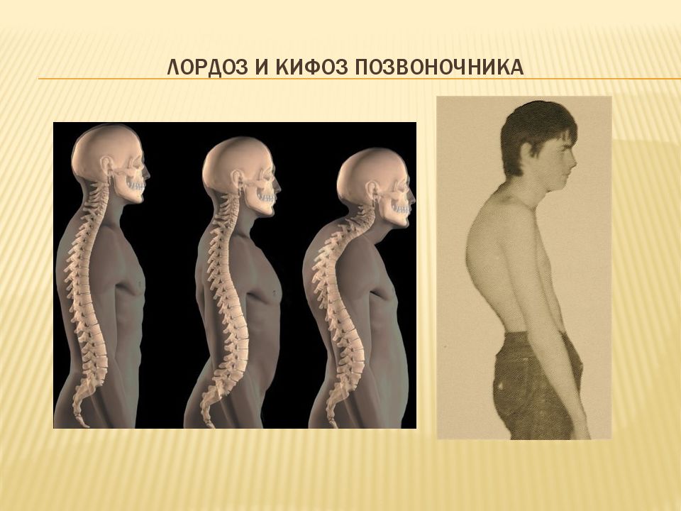 Степени кифоза позвоночника. Лордоз грудного отдела позвоночника. Лордоз и кифоз позвоночника. Шейный кифоз.