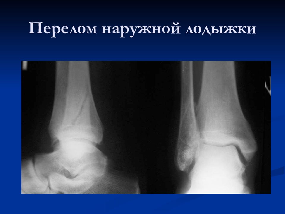 Как выглядит внутренний перелом ноги Лучевая диагностика повреждений нижней конечности и таза - презентация