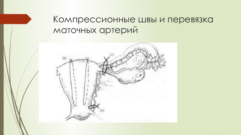 Перевязка маточных сосудов. Гемостатические компрессионные швы. Перевязка маточно-яичниковых сосудов. Перевязка маточных, яичниковых артерий.