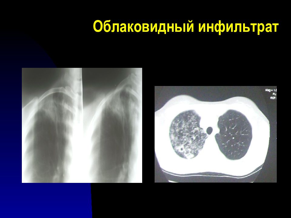 Лучевая диагностика органов дыхания презентация