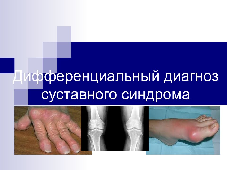 Дифференциальный диагноз суставного синдрома
