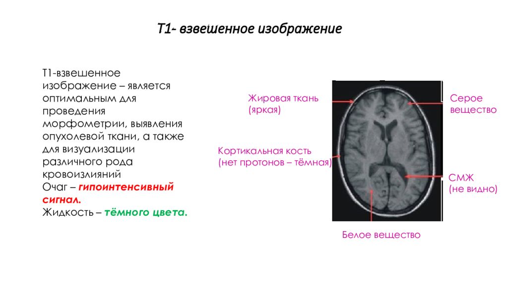 Т1 взвешенное изображение мрт