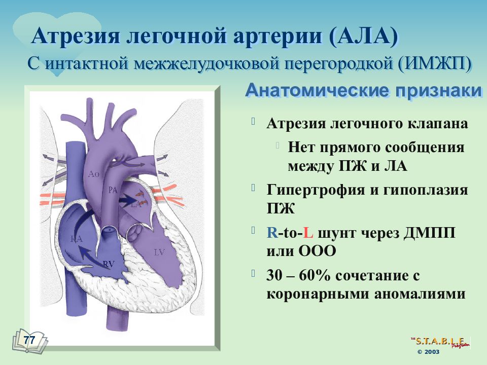 Ала сердца. Атрезия клапана легочной артерии 1 типа. Атрезия легочной артерии 4 Тип. Атрезия легочной артерии 1 Тип ДМЖП. Атрезия легочной артерии с ДМЖП.