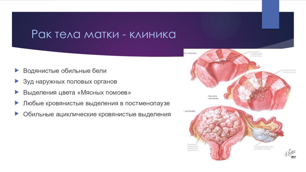 Размеры опухоли матки. Злокачественные новообразования тела матки. Новообразования наружных половых органов.