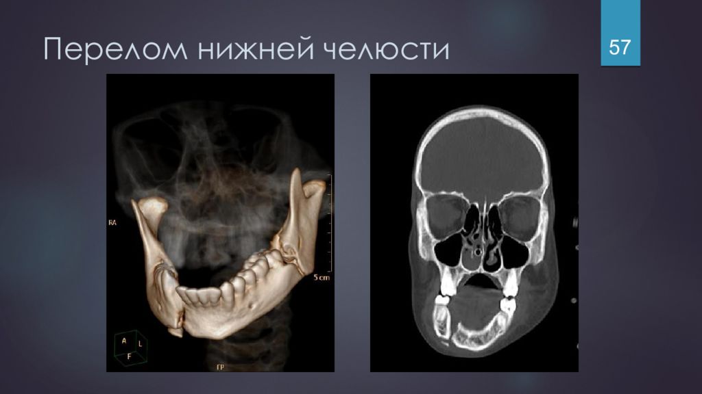 Травмы челюстно лицевой области стоматология презентация