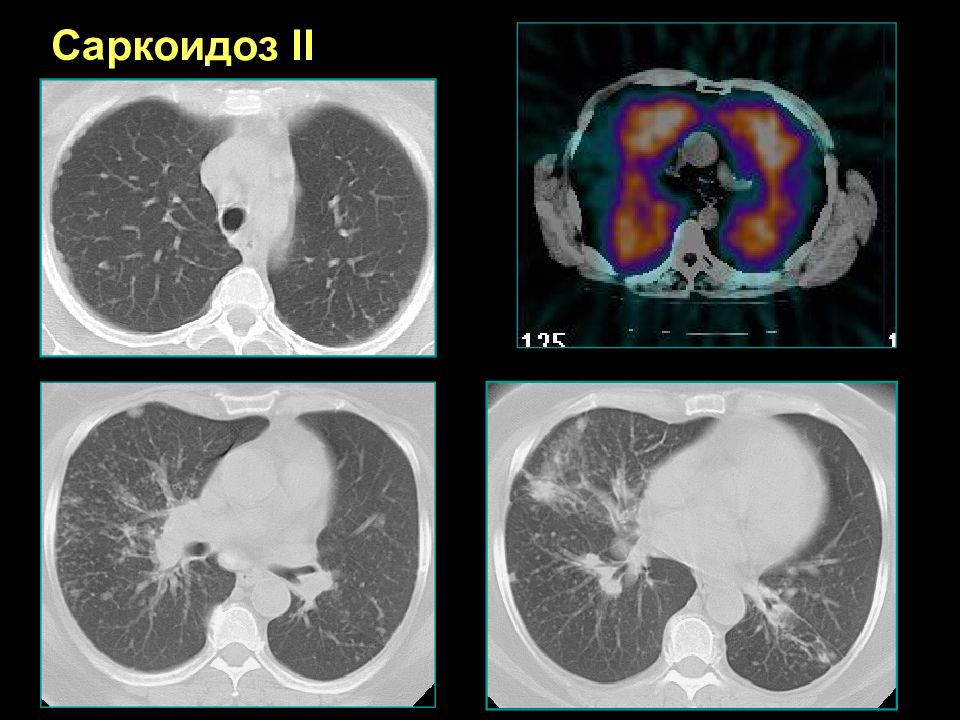 Кт картина саркоидоза легких