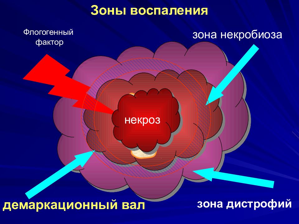 Что такое воспаление. Флогогенные факторы воспаления. Зона демаркационного воспаления. Флогогенный фактор это.