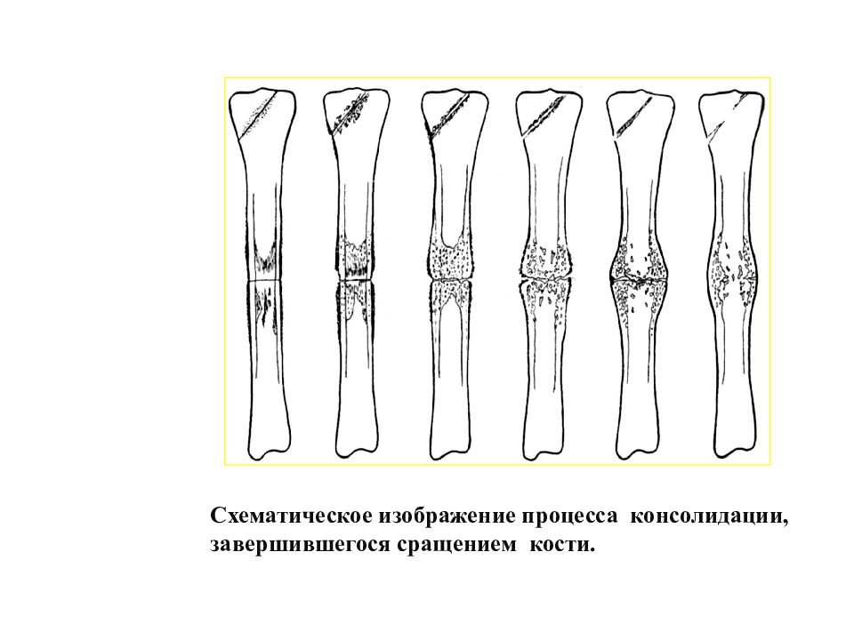 Образована тремя сросшимися костями. Консолидация костных отломков. Стадии сращения перелома. Стадии консолидации перелома на рентгене. Этапы срастания кости при переломе.