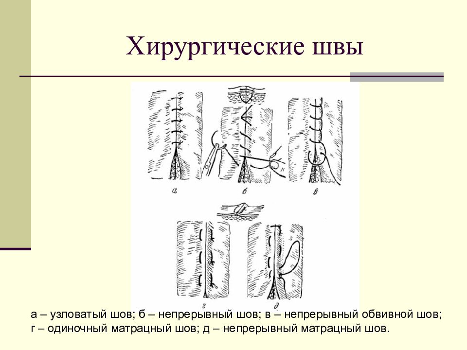 Как восстановить повреждения с вертикальными …