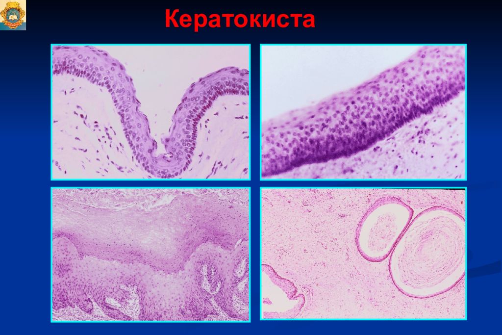 Опухоли опухолеподобные поражения и кисты кожи лица презентация