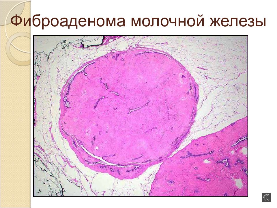 Фиброаденома молочной железы презентация