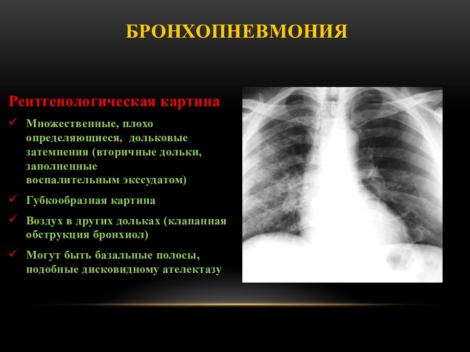 Картина пневмонии. Правосторонняя бронхопневмония рентген. Бронхопневмония у детей рентген. Нижнедолевая бронхопневмония. Лучевая диагностика бронхопневмония.