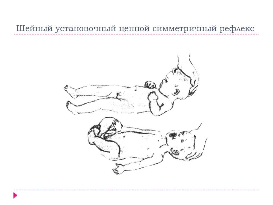 Рефлекс галанта у новорожденных. Симметричный шейный тонический рефлекс. Шейно-тонический рефлекс новорожденного. Цепной установочный рефлекс с туловища на туловище. Ассиметричный шейно-тонический рефлекс.