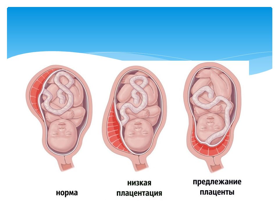 Предлежание плаценты презентация