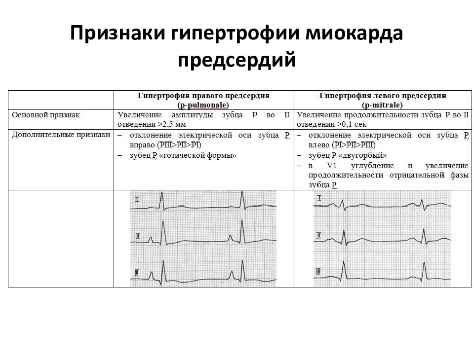 Гипертрофия желудочков на экг. Признаки гипертрофии предсердий на ЭКГ. Гипертрофия предсердий на ЭКГ. Электрокардиограмма при гипертрофиях предсердий и желудочков. Признаки гипертрофии миокарда на ЭКГ.