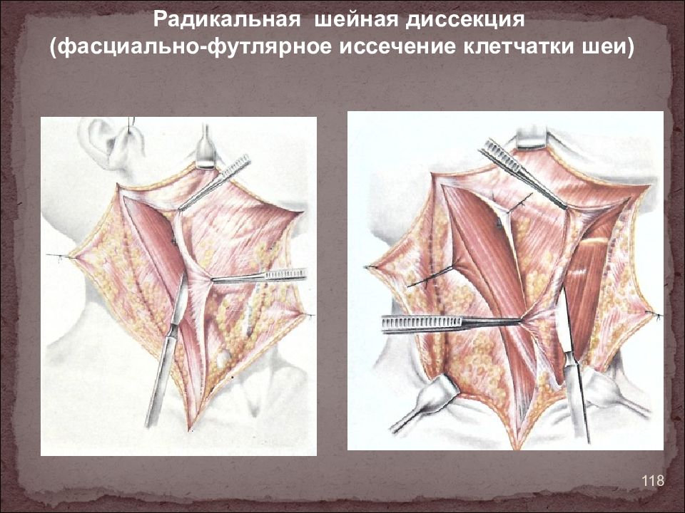 Субтотальная резекция щитовидной железы презентация. Разрез кохера при резекции щитовидной железы. Трахеостомия интубация. Субтотальная резекция щитовидной железы по кохеру. Срединные и боковые свищи шеи.