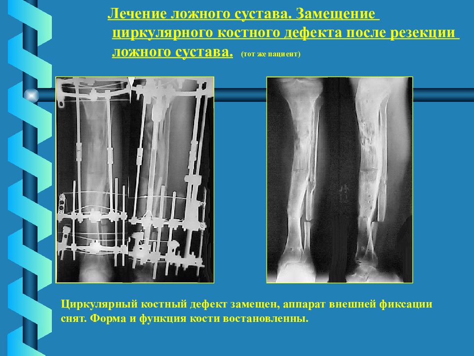 Ложный сустав. Причины формирования ложного сустава. Образование ложного сустава. Атрофический ложный сустав.