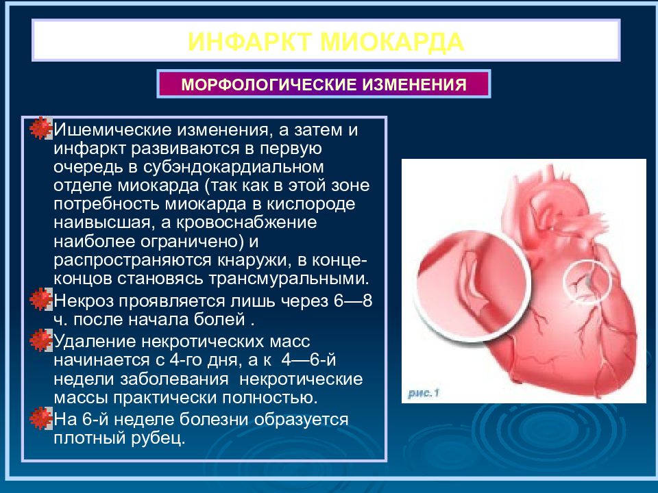 Картинки симптомы инфаркта миокарда