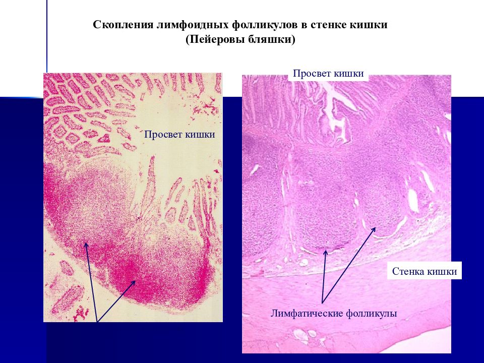 Укажите отделы кишечника имеющие в своих стенках лимфоидные бляшки