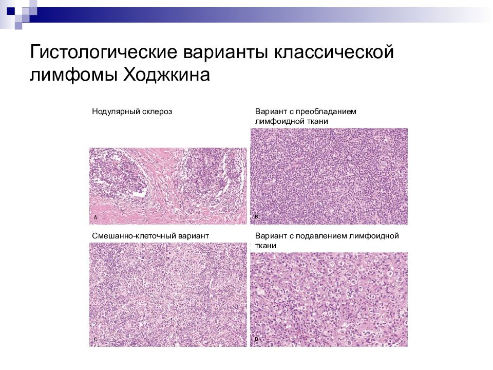 Лимфогранулематоз нодулярный склероз микропрепарат. Гистологические формы лимфомы Ходжкина. Гистологическая классификация лимфомы Ходжкина. Лимфома Ходжкина патанатомия препарат.