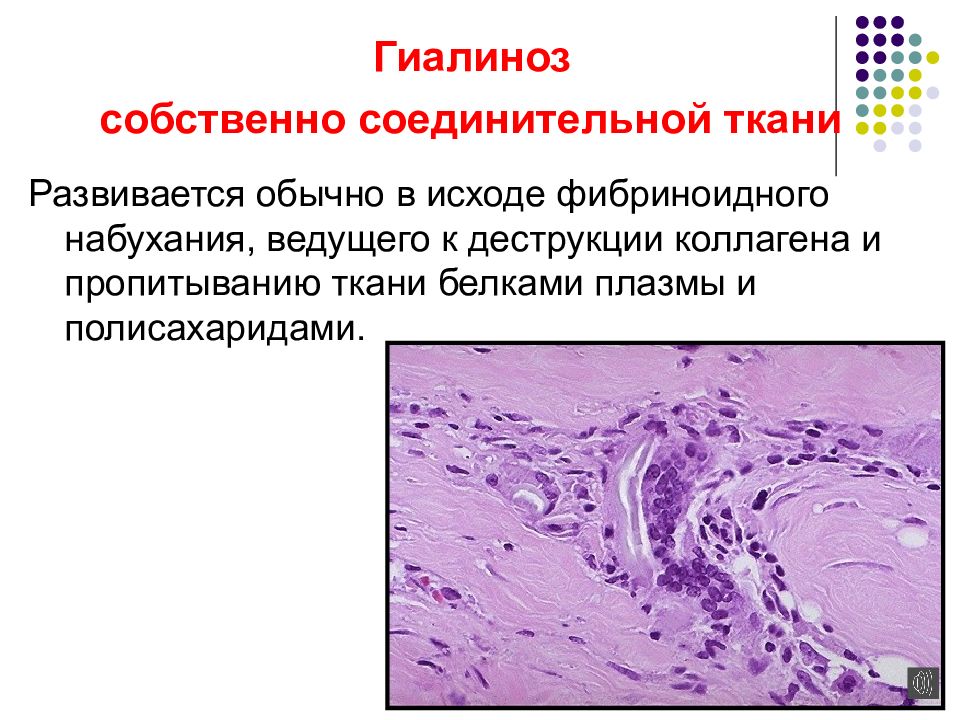 Гиалиноз относится к. Гиалиноз соединительной ткани почки. Фибриноидное набухание соединительной ткани. Собственно соединительная ткань.