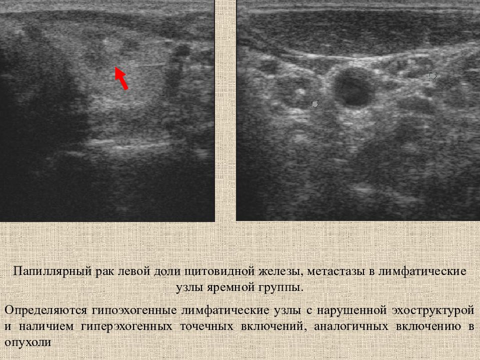 Усиление сосудистого рисунка щитовидной железы