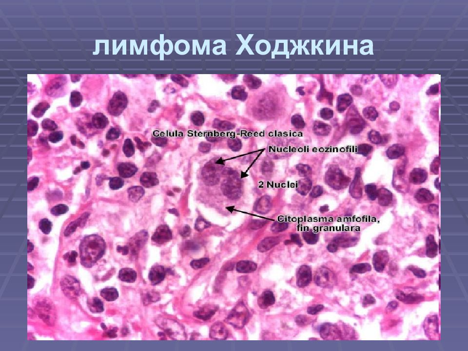 лимфома ходжкина микропрепарат