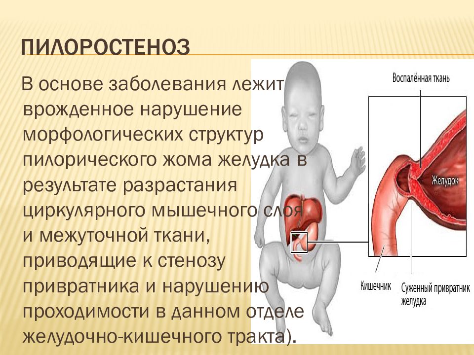 Врожденный пилоростеноз презентация