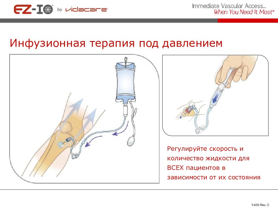 3 инфузионная терапия. Внутрикостное Введение лекарственных средств. Инфузионная терапия. Инфузионная терапия капельницы. Внутрикостный путь введения.