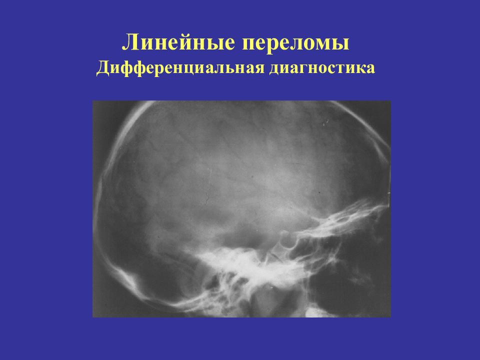 Линейная трещина. Линейный перелом сосцевидного отростка.