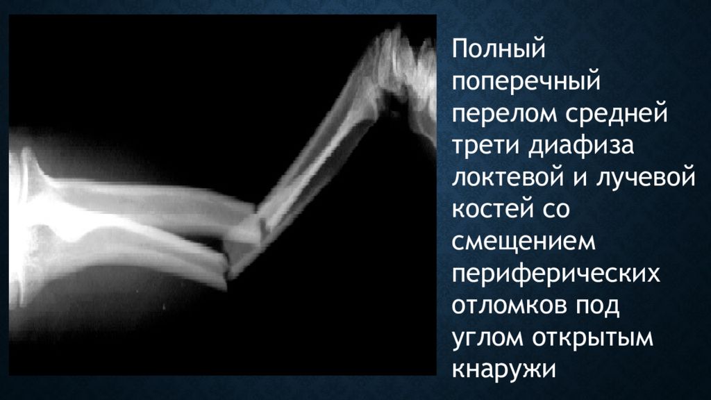 Средняя треть плечевой кости. Перелом диафизов локтевой и лучевой костей. Перелом средней трети диафиза плечевой кости. Перелом костей локтевой и лучевой закрытый. Перелом локтевой в диафизе.