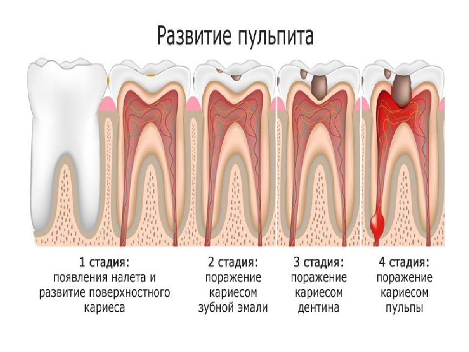 Пульпит и кариес отличия