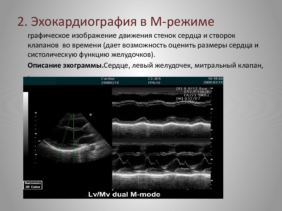 Эхокардиография сердца что это такое. М-режим ультразвукового исследования. Эхокардиография м режим. А режим ультразвукового исследования. Одномерный режим ЭХОКГ.