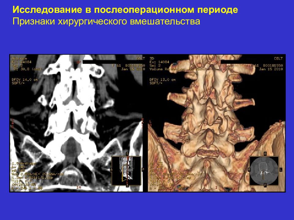 Исследование позвоночника. МР диагностика патологии позвоночника лекция. Патология позвоночника по УЗИ У детей. Компот исследование позвоночника.