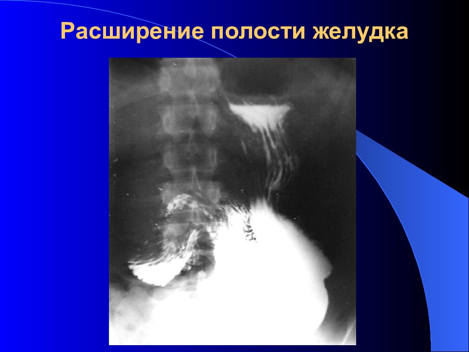 Полость расширена. Рентгенодиагностика заболеваний желудка. Рентгенодиагностика патологии ЖКТ. Расширение полости желудка. Заболевания желудка рентгенология.