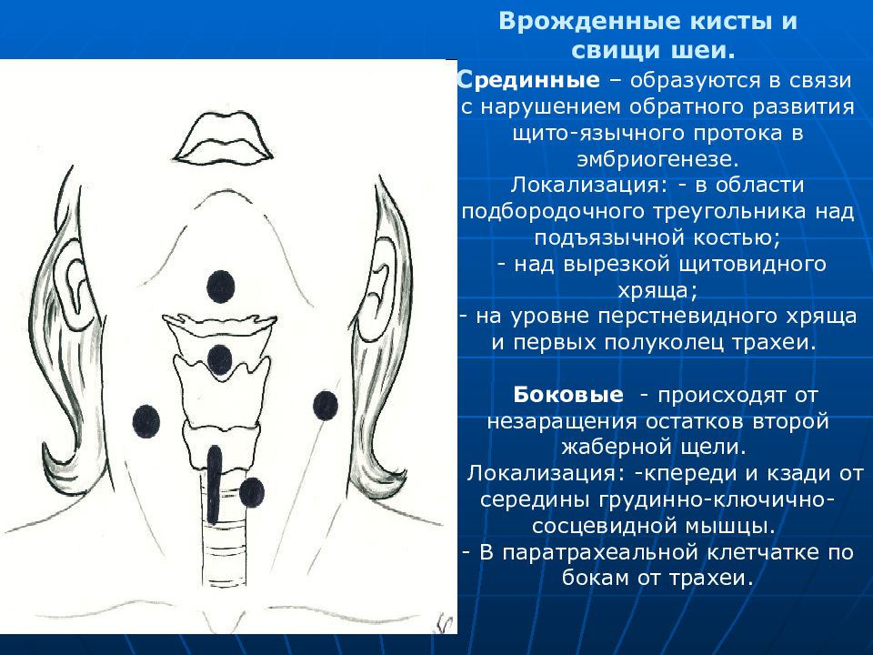 Средняя киста