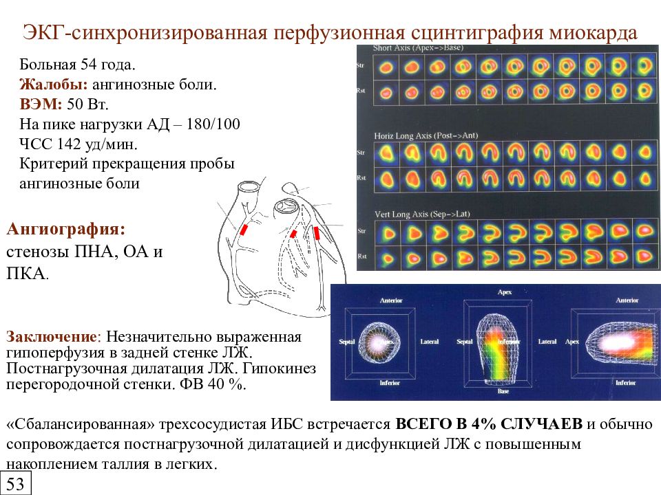 Презентация сцинтиграфия миокарда