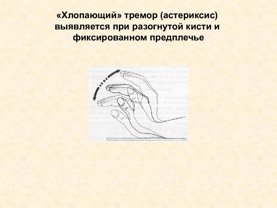 Что такое тремор. Тремор астериксис. Порхающий тремор астериксис. Хлопающий тремор. Астериксис хлопающий тремор.