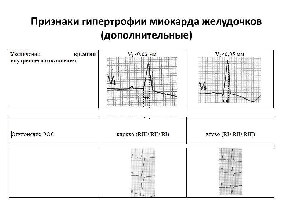 Гипертрофия миокарда рисунок