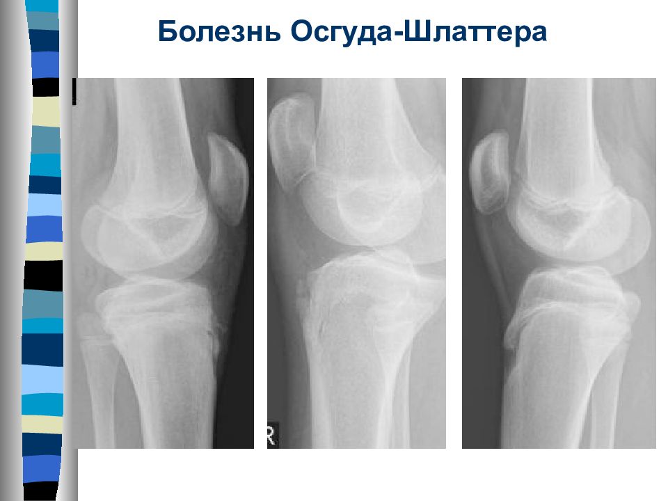 Картина болезни осгуд шляттера