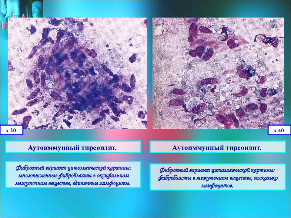 Цитологическая картина тиреоидита хашимото