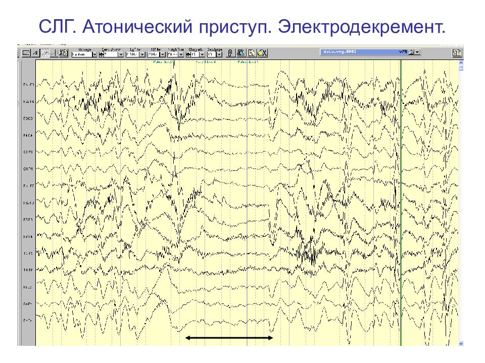 Ээг эпилепсия картинки