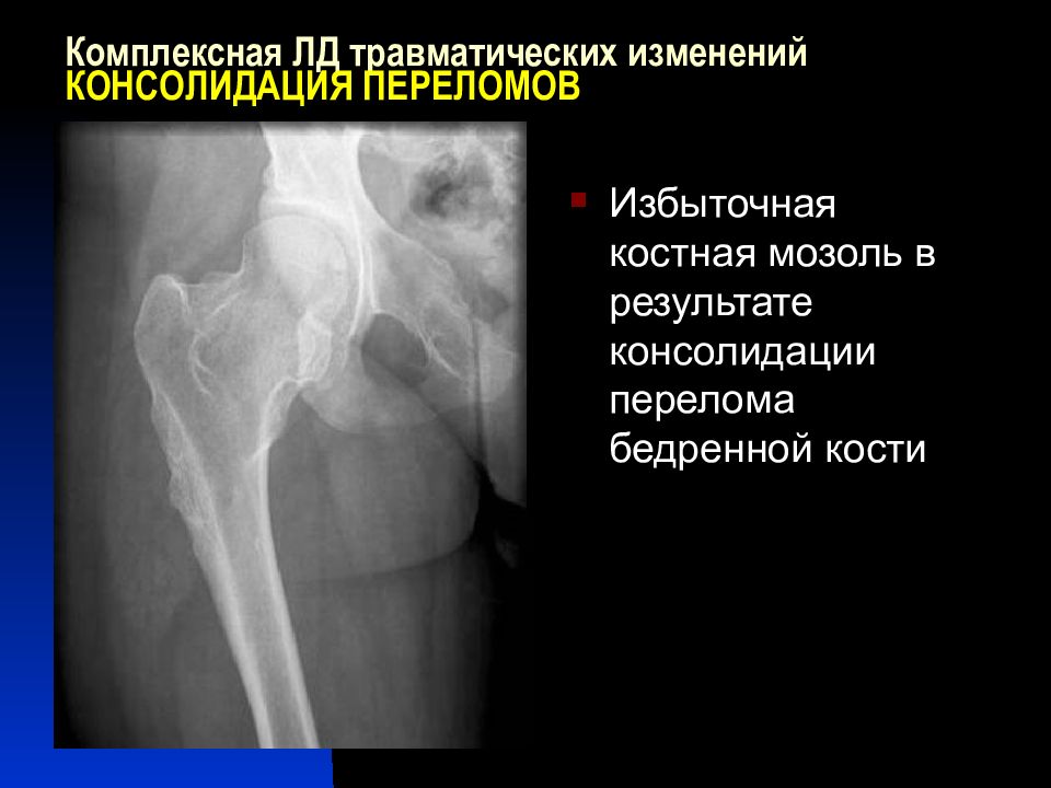 Консолидирующий перелом. Рентген признаки консолидации перелома. Стадии консолидации перелома на рентгене. Степень консолидации перелома рентген. Неправильно консолидированный перелом.